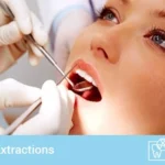Tooth extraction cost without insurance